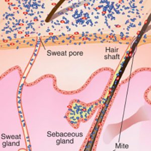 Flore cutanée : quand le système immunitaire ne suffit plus!