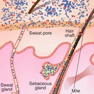 Flore cutanée : quand le système immunitaire ne suffit plus!