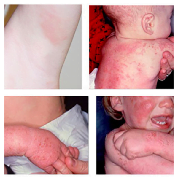 Eczéma ou réaction allergique : comment les différencier ?