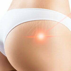 Utilisation des lasers pour traiter les vergetures